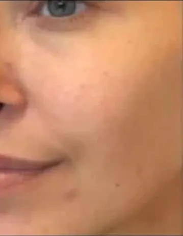After — Uneven Tone & Redness